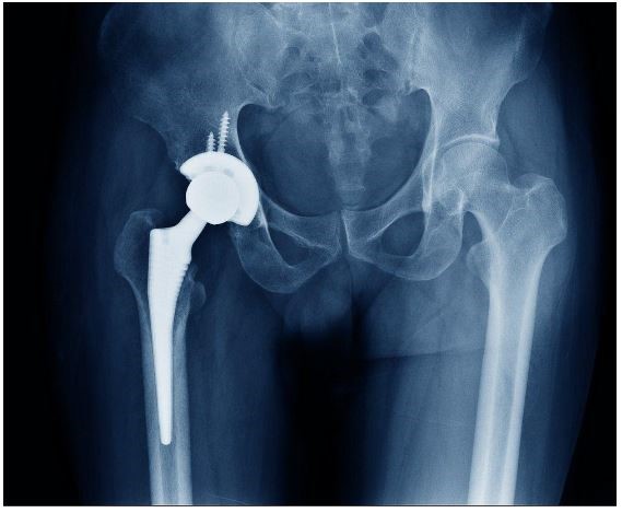 best total hip replacement in West Delhi