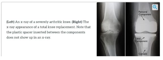 best total knee replacement in West Delhi